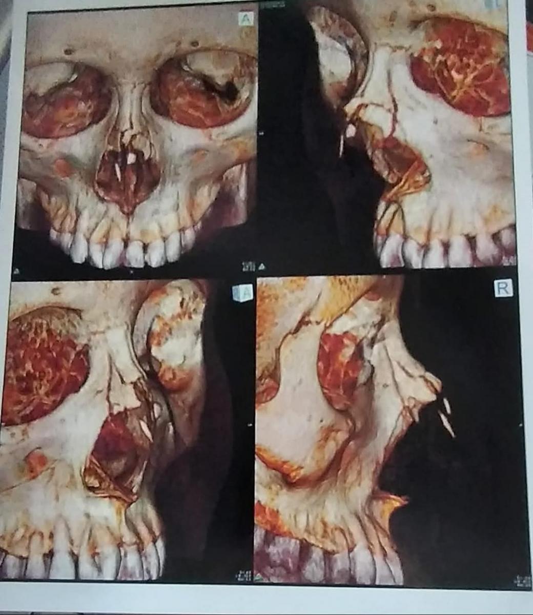fracturas_acoso_escolar.jpg